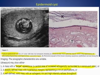 Epidermoid cyst
 