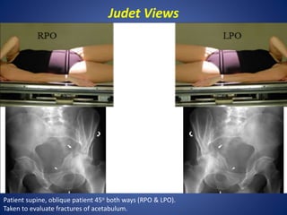 Judet Views
Patient supine, oblique patient 45o both ways (RPO & LPO).
Taken to evaluate fractures of acetabulum.
 