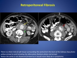 Retroperitoneal Fibrosis
There is a thick rind of soft tissue surrounding the aorta from the level of the kidneys (top photo-
yellow arrow) to and including the bifurcation (bottom photo-red arrow).
Notice the aorta is not displaced forward as it would more likely be in lymphoma.
 