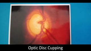 Ophthalmology OSCE | PPTX