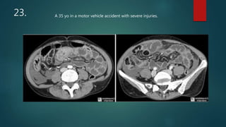 23. A 35 yo in a motor vehicle accident with severe injuries.
 