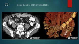 25. 81 YEAR OLD WITH HISTORY OF NON VEG DIET.
 