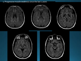 1. Progressive muscle weakness since the last 2 years
 