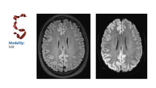 Key Neuroradiology Signs and Their Clinical Implications in CNS ...