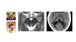 Key Neuroradiology Signs and Their Clinical Implications in CNS ...