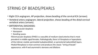 Key Neuroradiology Signs and Their Clinical Implications in CNS ...