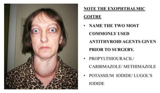 NOTE THE EXOPHTHALMIC
GOITRE
• NAME THE TWO MOST
COMMONLY USED
ANTITHYROID AGENTS GIVEN
PRIOR TO SURGERY.
• PROPYLTHIOURAC...