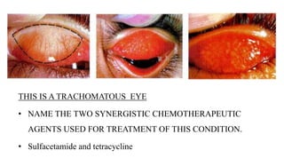 THIS IS A TRACHOMATOUS EYE
• NAME THE TWO SYNERGISTIC CHEMOTHERAPEUTIC
AGENTS USED FOR TREATMENT OF THIS CONDITION.
• Sulf...