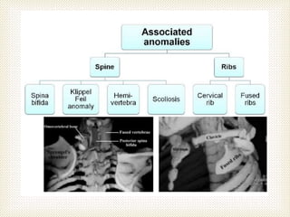 Springer Scapula Sprengle shoulder (congenital elevation of scapula) | PPTX