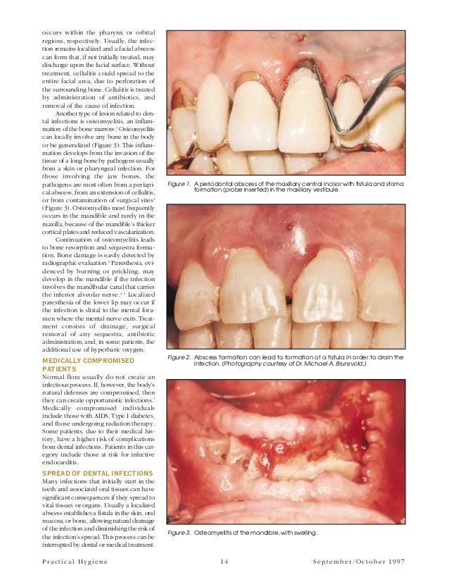 Spread of dental infection pdf