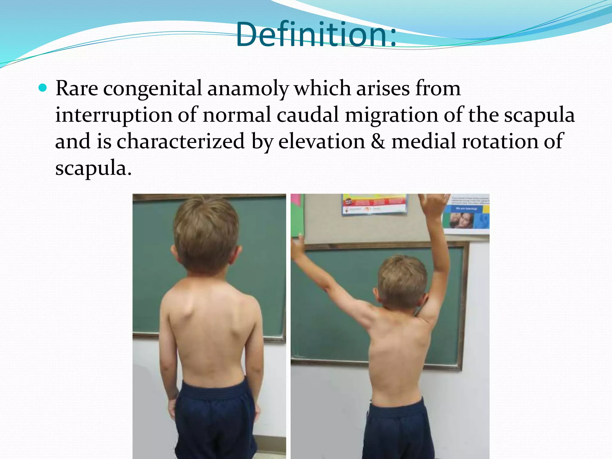 Spangles Defect Sprengel deformity | PPTX