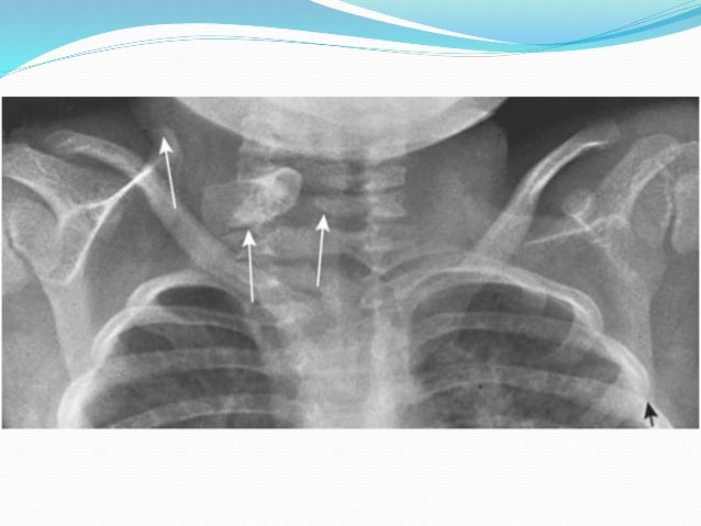 Sprengel deformity
