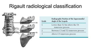 Example Radiological Classification Drawing Sprengel deformity presentation by doctor | PPTX