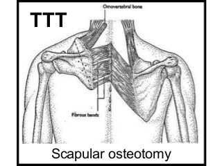 TTT

Scapular osteotomy

 