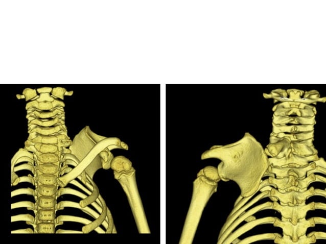 Sprengel's shoulder | PPT