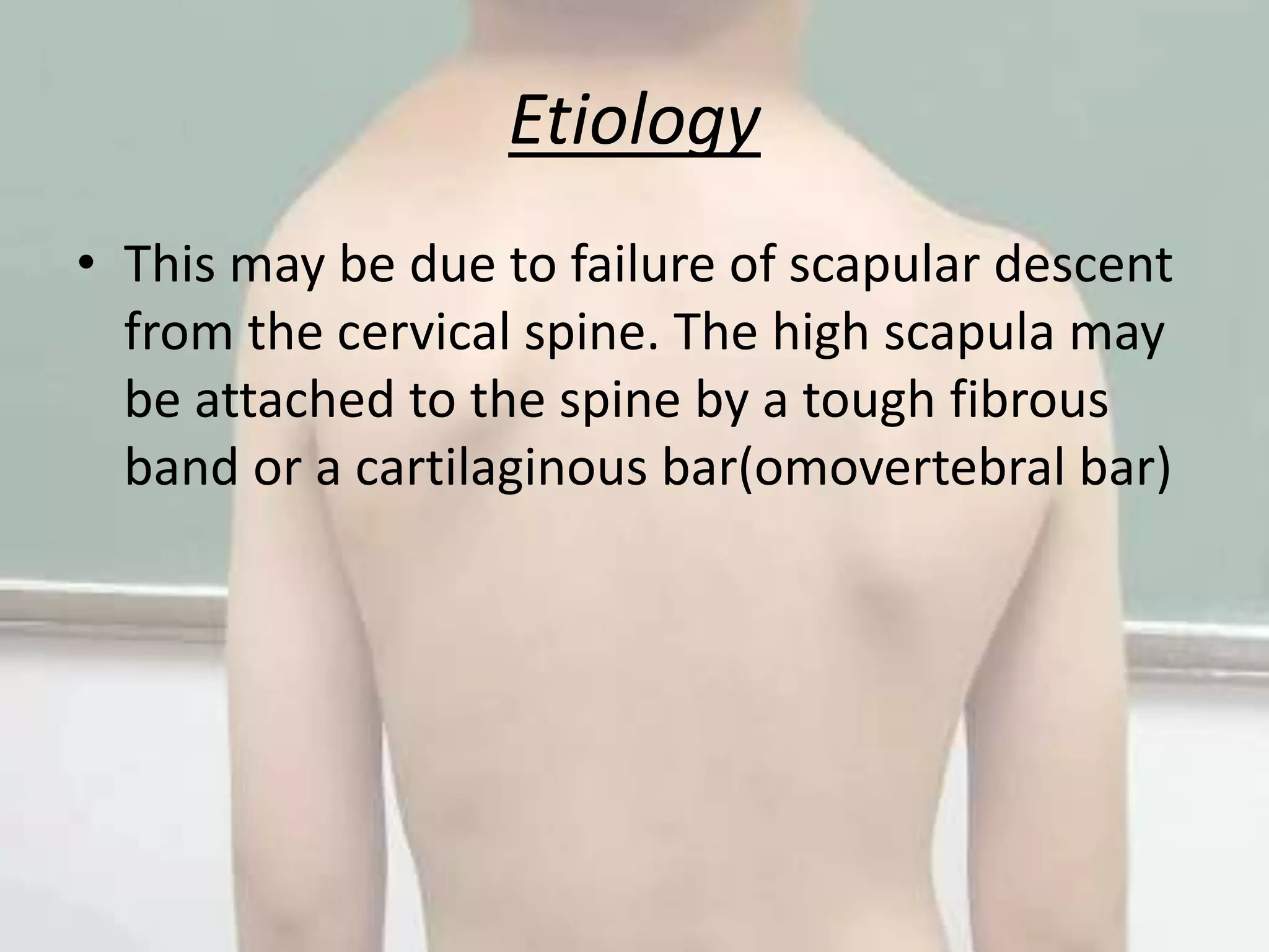 Spangles Defect Sprengel’s shoulder | PPTX