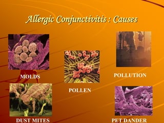 Allergic Conjunctivitis : Causes
POLLEN
PET DANDER
POLLUTION
DUST MITES
MOLDS
 