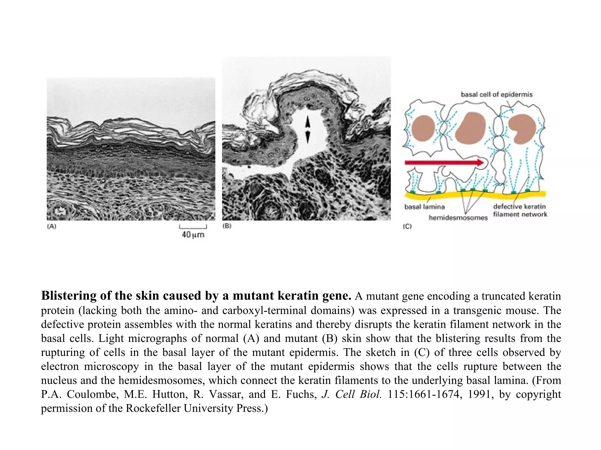 Blistering of the skin caused by a mutant keratin gene.   A mutant gene encoding a truncated keratin protein (lacking both the amino- and carboxyl-terminal domains) was expressed in a transgenic mouse. The defective protein assembles with the normal keratins and thereby disrupts the keratin filament network in the basal cells. Light micrographs of normal (A) and mutant (B) skin show that the blistering results from the rupturing of cells in the basal layer of the mutant epidermis. The sketch in (C) of three cells observed by electron microscopy in the basal layer of the mutant epidermis shows that the cells rupture between the nucleus and the hemidesmosomes, which connect the keratin filaments to the underlying basal lamina. (From P.A. Coulombe, M.E. Hutton, R. Vassar, and E. Fuchs,  J. Cell Biol.  115:1661-1674, 1991, by copyright permission of the Rockefeller University Press.) 