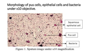 Morphology of pus cells, epithelial cells and bacteria
under x10 objective.
 