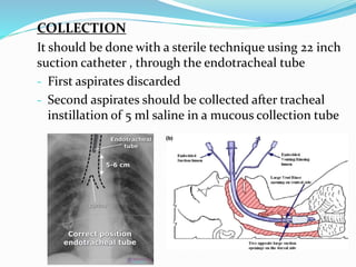 COLLECTION
It should be done with a sterile technique using 22 inch
suction catheter , through the endotracheal tube
- First aspirates discarded
- Second aspirates should be collected after tracheal
instillation of 5 ml saline in a mucous collection tube
 