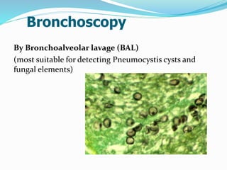 Bronchoscopy
By Bronchoalveolar lavage (BAL)
(most suitable for detecting Pneumocystis cysts and
fungal elements)
 