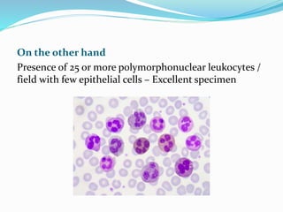 On the other hand
Presence of 25 or more polymorphonuclear leukocytes /
field with few epithelial cells – Excellent specimen
 