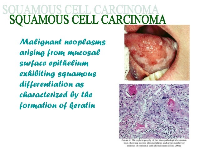 Management of Squamous cell carcinoma