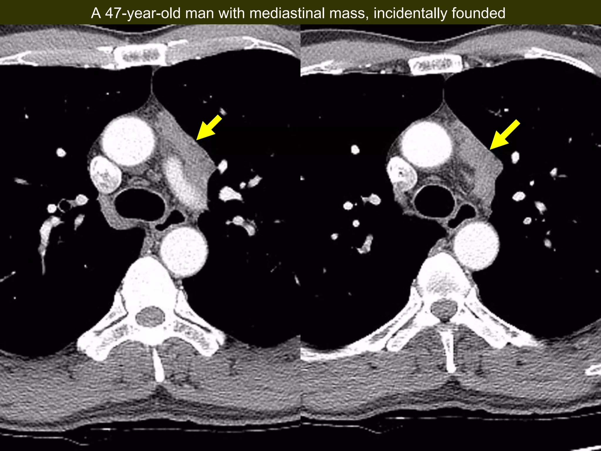 Chest CT A 47-year-old man with mediastinal mass, incidentally founded
