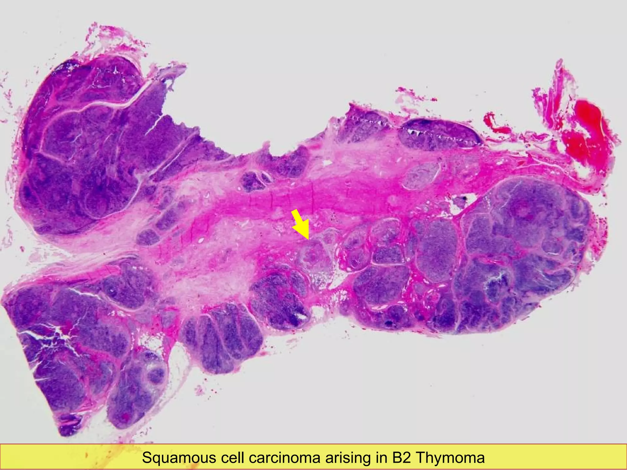 Close view Squamous cell carcinoma arising in B2 Thymoma