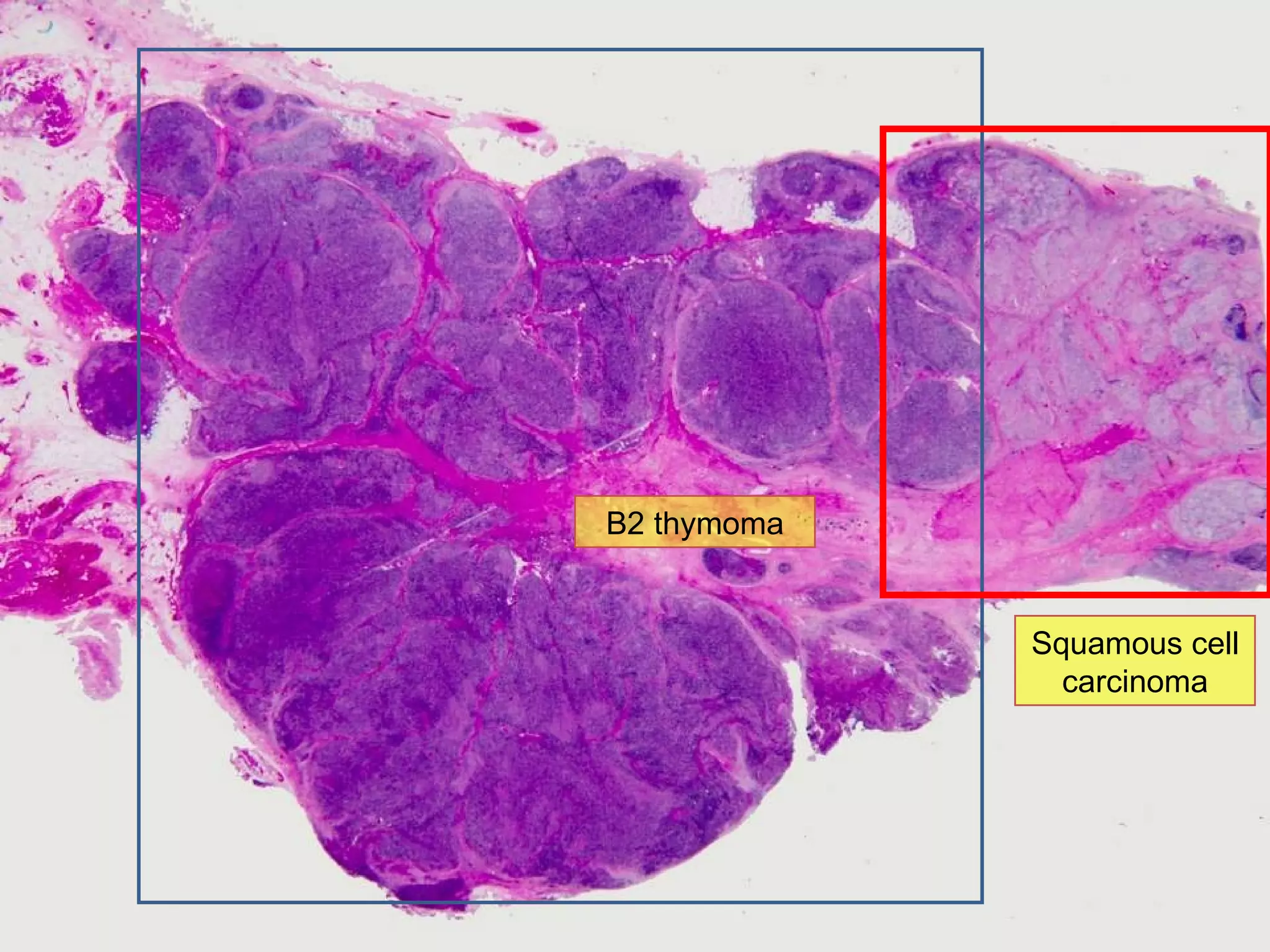 Close view B2 thymoma Squamous cell carcinoma