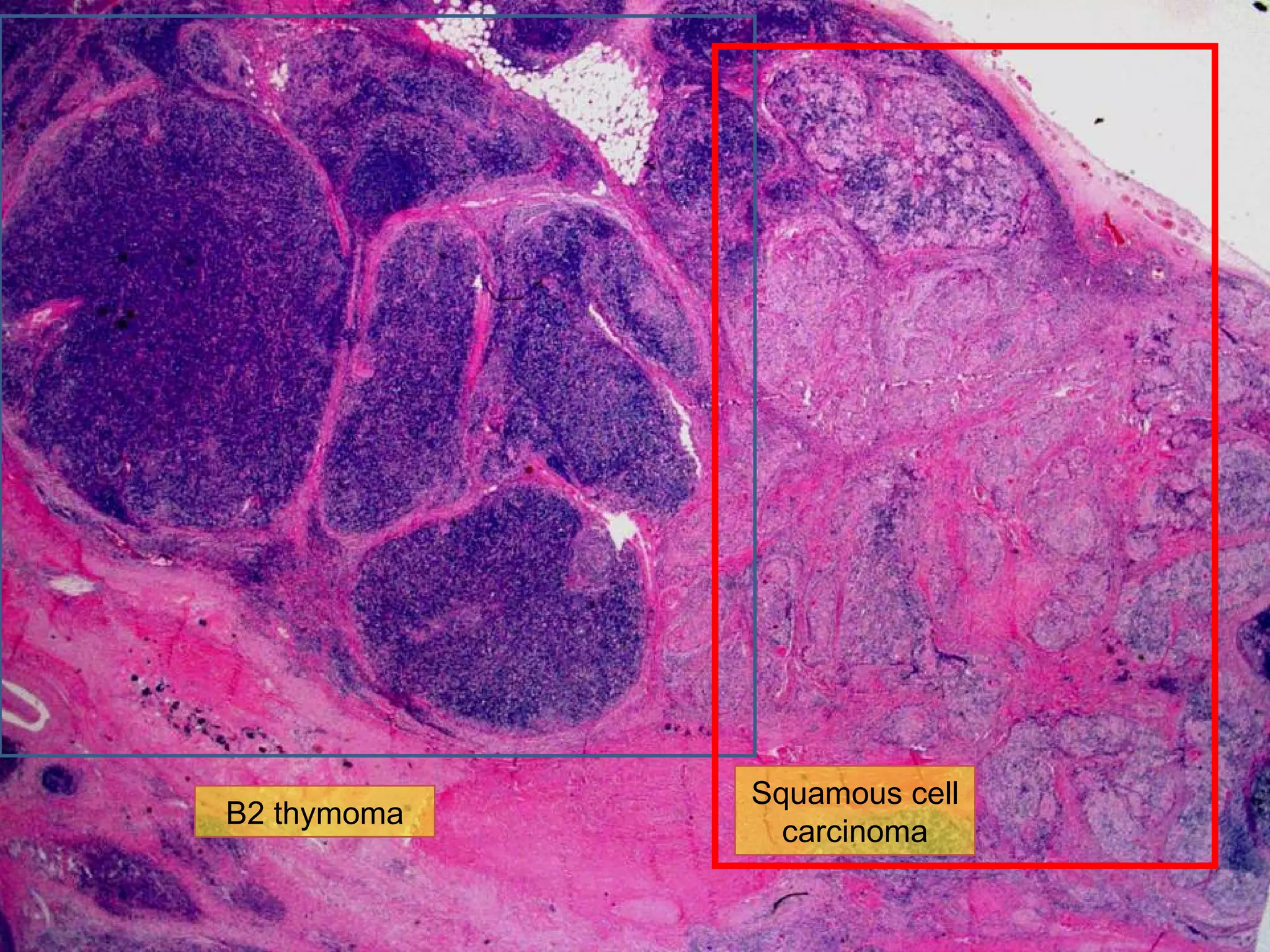 Low power view B2 thymoma Squamous cell carcinoma
