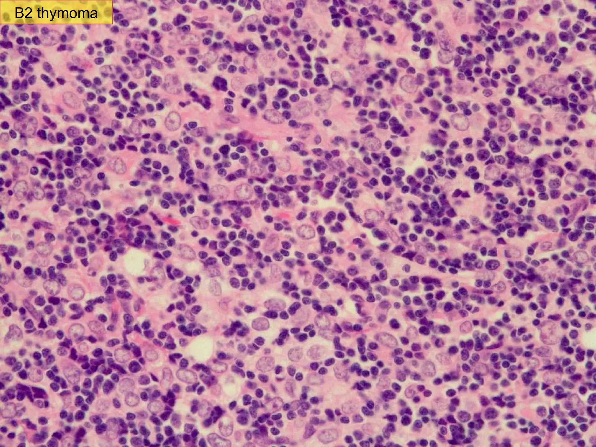 B2 thymoma area B2 thymoma