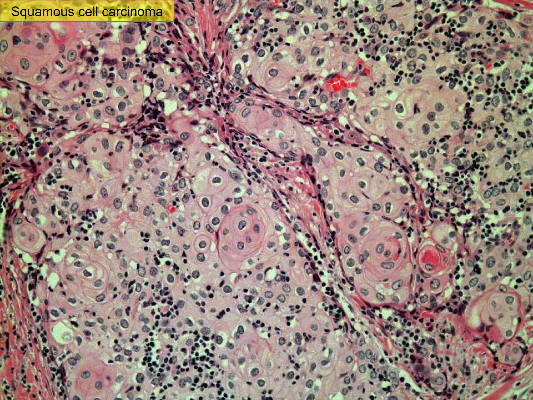 Sq C Ca Squamous cell carcinoma
