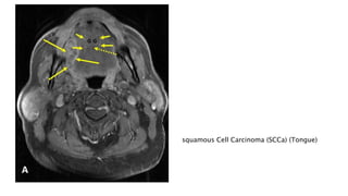 squamous Cell Carcinoma (SCCa) (Tongue)
 