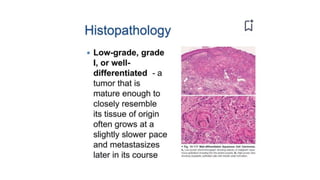 Squamous cell carcinoma.pptxpresentation