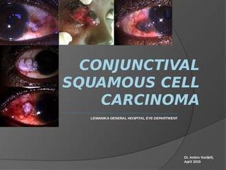 CONJUNCTIVAL
SQUAMOUS CELL
CARCINOMA
 