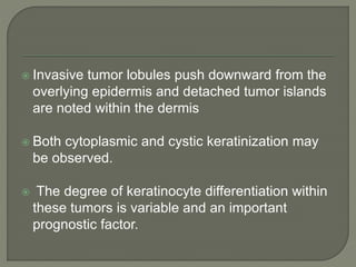  Invasive tumor lobules push downward from the
overlying epidermis and detached tumor islands
are noted within the dermis
 Both cytoplasmic and cystic keratinization may
be observed.
 The degree of keratinocyte differentiation within
these tumors is variable and an important
prognostic factor.
 