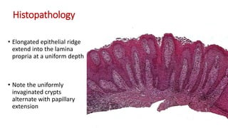 Wpithelial Ridge Formation Squamous Papilloma and Verruciform Xanthoma (Doctor Faris Alabeedi MSc ...