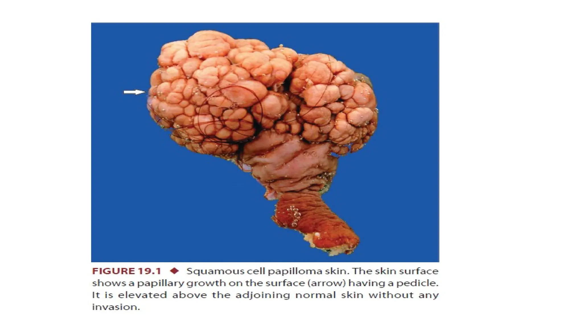 SQUAMOUS PAPILLOMA.pathology bds practical pptx | PPTX
