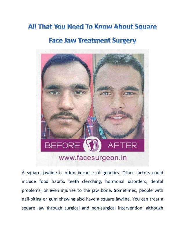 A square jawline is often because of genetics. Other factors could
include food habits, teeth clenching, hormonal disorders, dental
problems, or even injuries to the jaw bone. Sometimes, people with
nail-biting or gum chewing also have a square jawline. You can treat a
square jaw through surgical and non-surgical intervention, although
 
