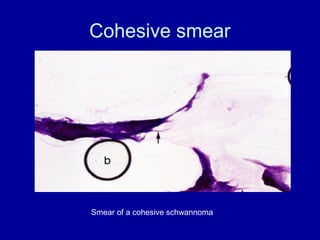 Squash cytology of cns paediatric tumours | PPT
