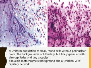 a) Uniform population of small, round cells without perinuclear
halos. The background is not fibrillary, but finely granular with
slim capillaries and tiny vacuoles
b)mucoid metachromatic background and a “chicken-wire”
capillary network
 