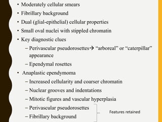 • Moderately cellular smears
• Fibrillary background
• Dual (glial-epithelial) cellular properties
• Small oval nuclei with stippled chromatin
• Key diagnostic clues
– Perivascular pseudorosettes “arboreal” or “caterpillar”
appearance
– Ependymal rosettes
• Anaplastic ependymoma
– Increased cellularity and coarser chromatin
– Nuclear grooves and indentations
– Mitotic figures and vascular hyperplasia
– Perivascular pseudorosettes
– Fibrillary background
Features retained
 