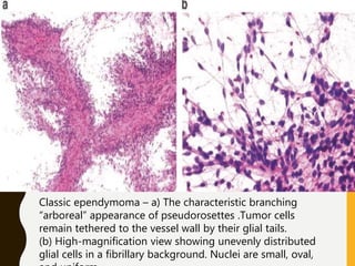 Classic ependymoma – a) The characteristic branching
“arboreal” appearance of pseudorosettes .Tumor cells
remain tethered to the vessel wall by their glial tails.
(b) High-magnification view showing unevenly distributed
glial cells in a fibrillary background. Nuclei are small, oval,
 