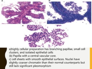 a)highly cellular preparation has branching papillae, small cell
clusters, and isolated epithelial cells
(b) Papilla with a central vascular core.
c) cell sheets with smooth epithelial surfaces. Nuclei have
slightly coarser chromatin than their normal counterparts but
still lack significant pleomorphism
 