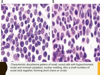 Characteristic discohesive pattern of small, round cells with hyperchromatic
nuclei and minimal cytoplasm, nuclear molding. Also a small numbers of
nuclei stick together, forming short chains or circles
 
