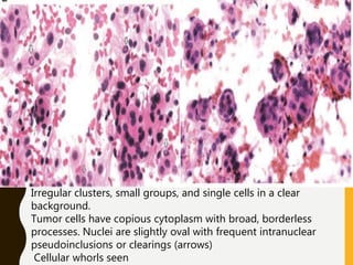 Irregular clusters, small groups, and single cells in a clear
background.
Tumor cells have copious cytoplasm with broad, borderless
processes. Nuclei are slightly oval with frequent intranuclear
pseudoinclusions or clearings (arrows)
Cellular whorls seen
 