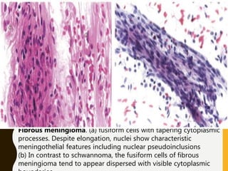 Fibrous meningioma. (a) fusiform cells with tapering cytoplasmic
processes. Despite elongation, nuclei show characteristic
meningothelial features including nuclear pseudoinclusions
(b) In contrast to schwannoma, the fusiform cells of fibrous
meningioma tend to appear dispersed with visible cytoplasmic
 