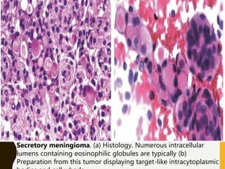 Secretory meningioma. (a) Histology. Numerous intracellular
lumens containing eosinophilic globules are typically (b)
Preparation from this tumor displaying target-like intracytoplasmic
 