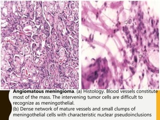 Angiomatous meningioma. (a) Histology. Blood vessels constitute
most of the mass. The intervening tumor cells are difficult to
recognize as meningothelial.
(b) Dense network of mature vessels and small clumps of
meningothelial cells with characteristic nuclear pseudoinclusions
 